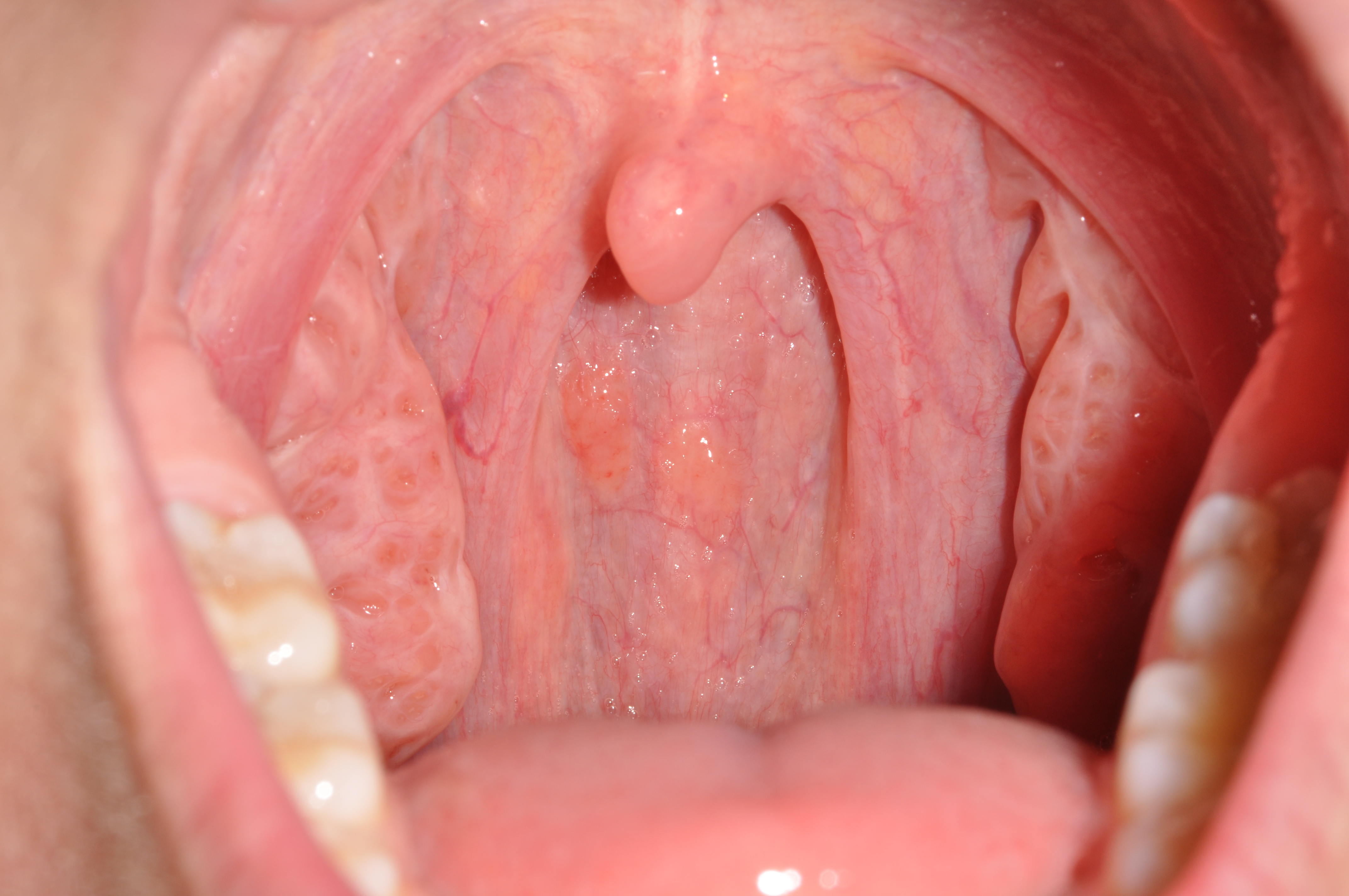 Oral Throat 41