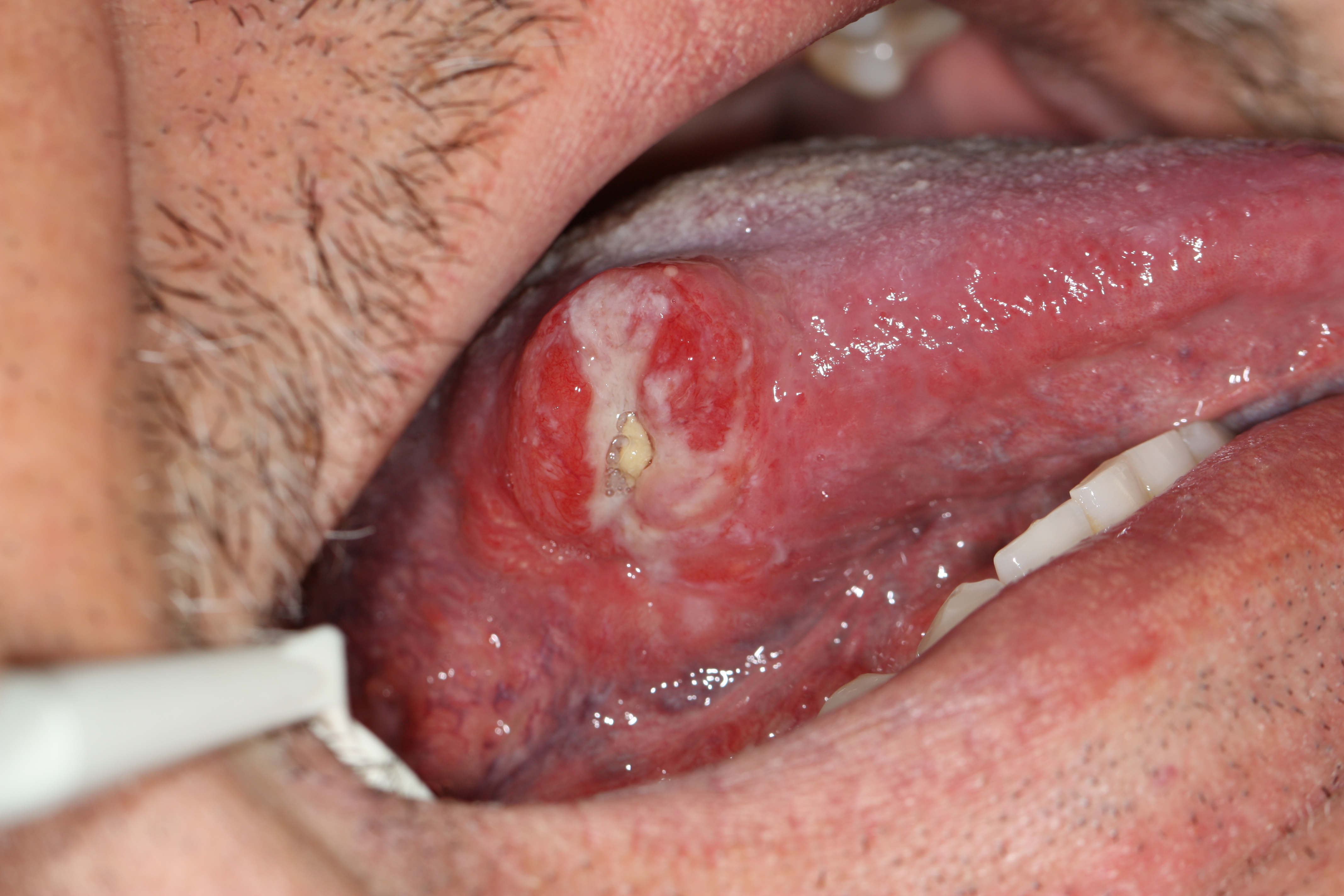 Pictures of oral cancer palate — pic 4