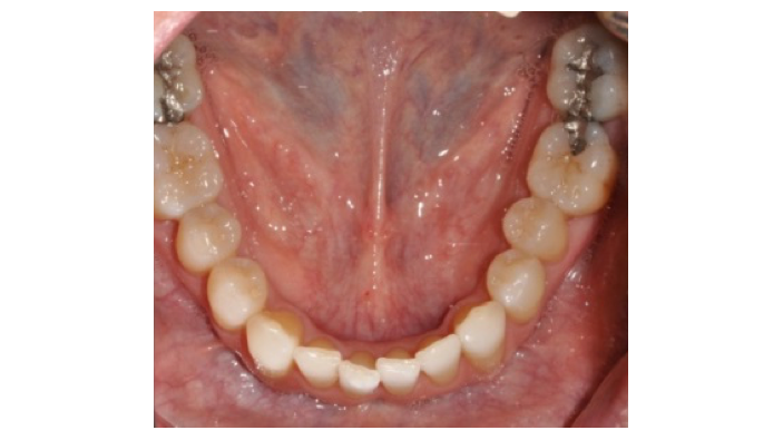 SOCS step 3 - floor of mouth 2