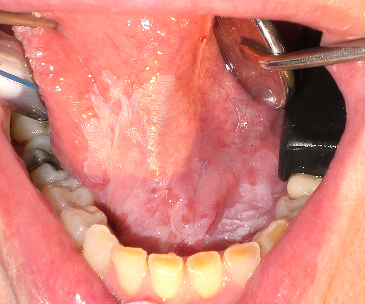 colorectal cancer metastasis to peritoneum