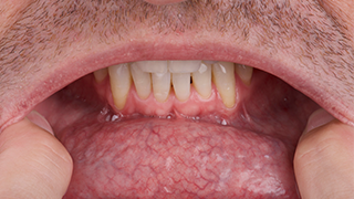 SOCS step 1 - lower lip and gums