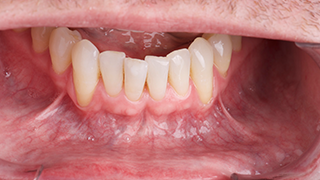SOCS step 2 - lower lip and gums 2