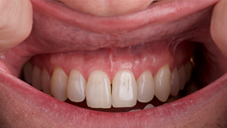 SOCS step 3 - upper lip and gums