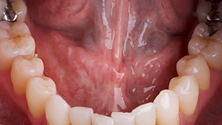 SOCS step 3 - floor of mouth