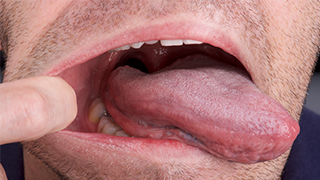 SOCS step 4 -side of tongue