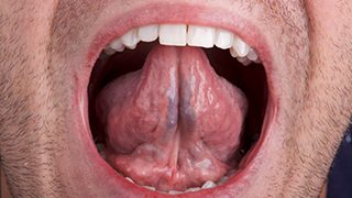 SOCS step 4 - undersurface of tongue