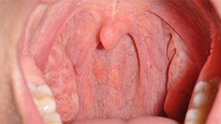 SOCS Step 5 - back of throat