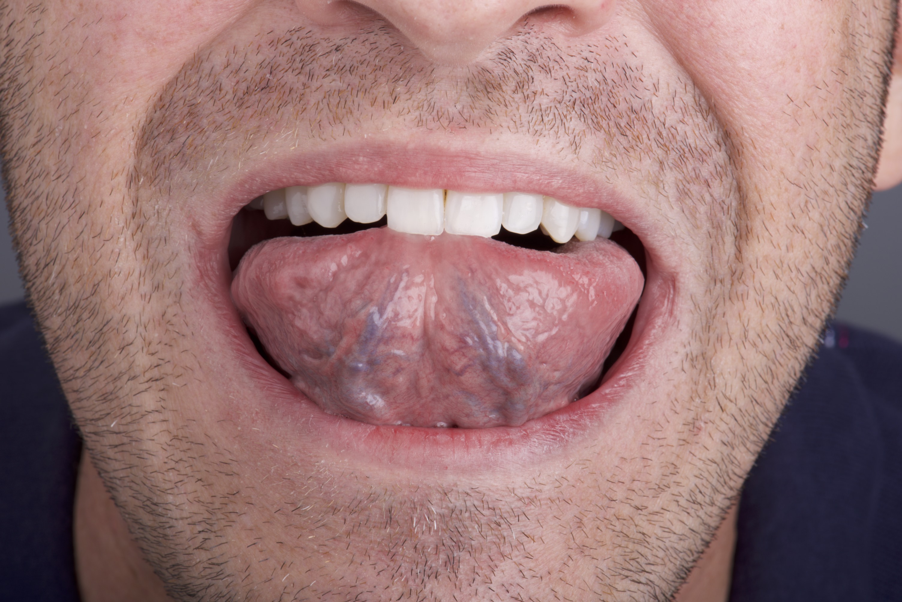 Self Oral Cancer Screening Socs Education Program School